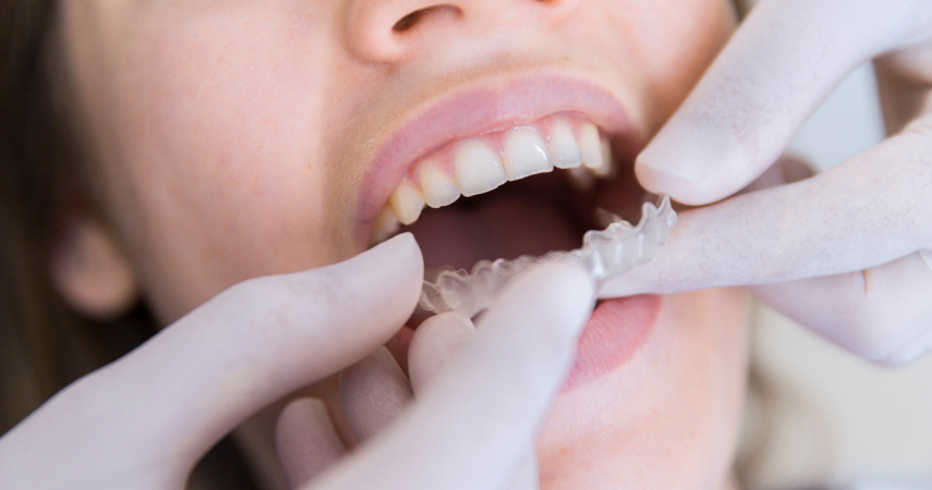 Aligneurs invisibles Cabinet d’orthodontie du Dr Matthieu Soto à Miramas