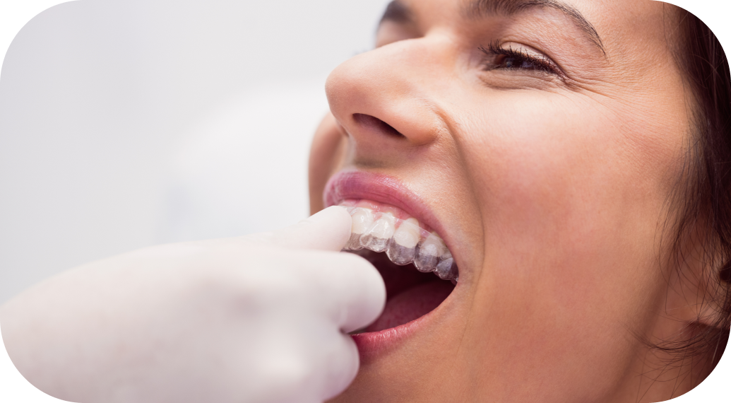 Aligneurs invisibles Cabinet d’orthodontie du Dr Matthieu Soto à Miramas