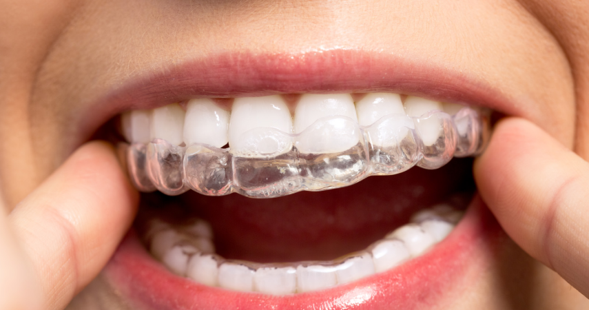 Aligneurs invisibles Cabinet d’orthodontie du Dr Matthieu Soto à Miramas